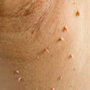 Warts Removal in Riyadh