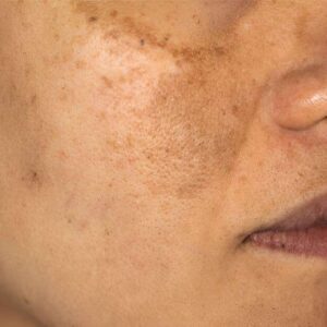 hyperpigmentation treatment in islamabad
