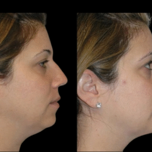 Double chin removal in Dubai