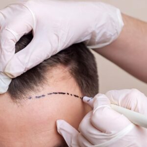 Scarless Hair Transplant in Dubai