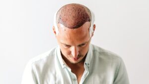 Scarless Hair Transplant in Dubai