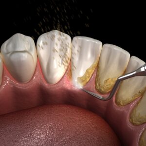Teeth Cleaning in Dubai
