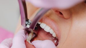 tooth cavity treatment