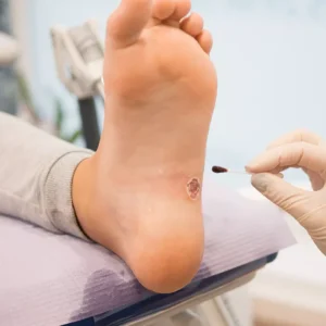 Mobile wound care nurse in Troy