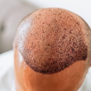 زراعة الشعر في الرياض