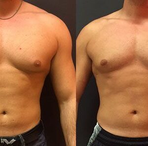 Gynecomastia in Islamabad