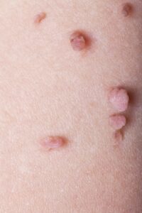 Advanced Skin Tag Removal Techniques