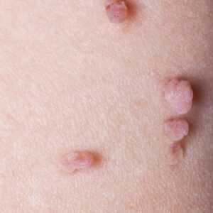Advanced Skin Tag Removal Techniques
