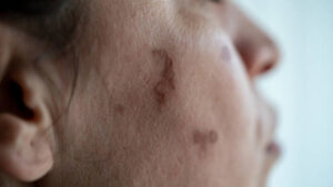 Birthmark removal in Dubai