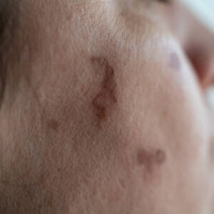 Birthmark removal in Dubai