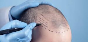 Experience Confidence Again with FUE Hair Transplant
