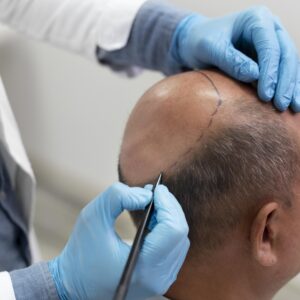 تكلفة زراعة الشعر في الرياض