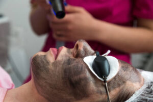 How Long Is Recovery After a Laser Carbon Peel?