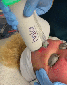 Is Halo Treatment Better Than Chemical Peels