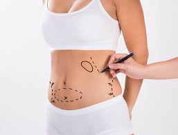 Liposuction in Islamabad