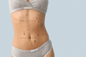 Mini Tummy Tuck Designed for Subtle Refinement