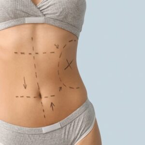 Mini Tummy Tuck Designed for Subtle Refinement