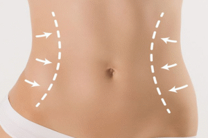 Restore Your Shape After Weight Loss with a Tummy Tuck