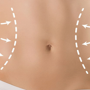 Restore Your Shape After Weight Loss with a Tummy Tuck