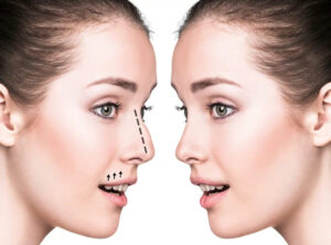 Rhinoplasty in Dubai
