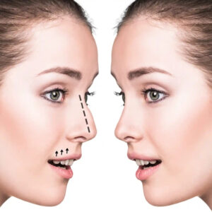 Rhinoplasty in Dubai