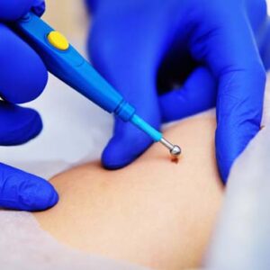 Safe Warts Removal for Long-Lasting Results