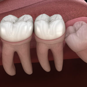 Signs You Need Wisdom Teeth Removal and How It Improves Oral Health