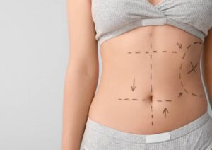 What Are the Risks of a Mini Tummy Tuck Surgery