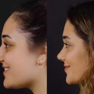 Rhinoplasty cost in Dubai