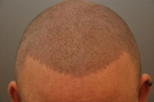 Why Scalp Micropigmentation Is the Future of Hair Loss Treatment