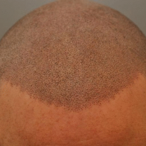 Why Scalp Micropigmentation Is the Future of Hair Loss Treatment