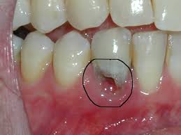 external resorption