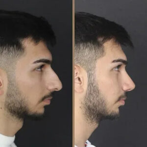Rhinoplasty in Islamabad