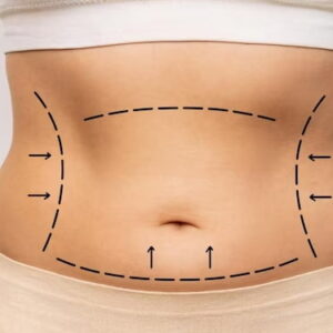 Tummy Tuck in Islamabad