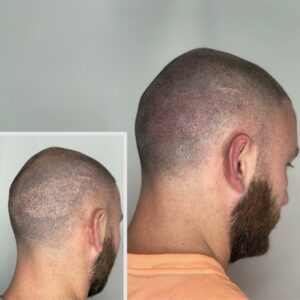 scar camouflage tattoo