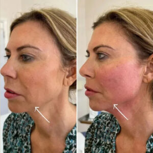 Best Plastic Surgeons in dubai Recommend Endolift for Subtle Enhancements