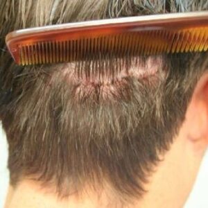 Hair Transplant in Riyadh