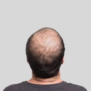 Hair transplant surgeon in islamabad