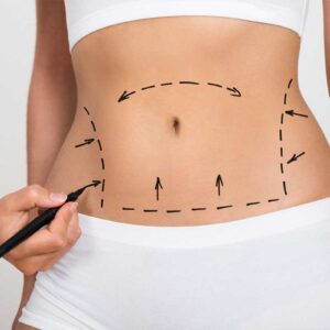 High-Definition Liposuction for Men and Women