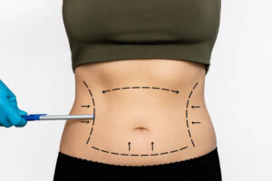 How Liposuction Compares to Tummy Tuck Surgery